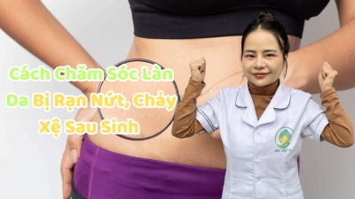 Cách Chăm Sóc Làn Da Bị Rạn Nứt, Chảy Xệ Sau Sinh Cách Chăm Sóc Làn Da Bị Rạn Nứt, Chảy Xệ Sau Sinh